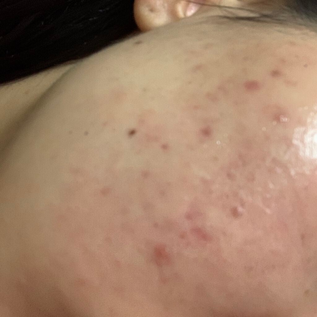 ペアアクネクリームW(医薬品)/ペア/その他を使ったクチコミ(2枚目)