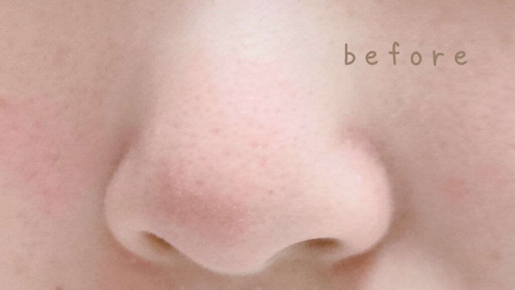 BLACK O2 泡パック charcoal /PUREDERM/シートマスク・パックを使ったクチコミ（2枚目）