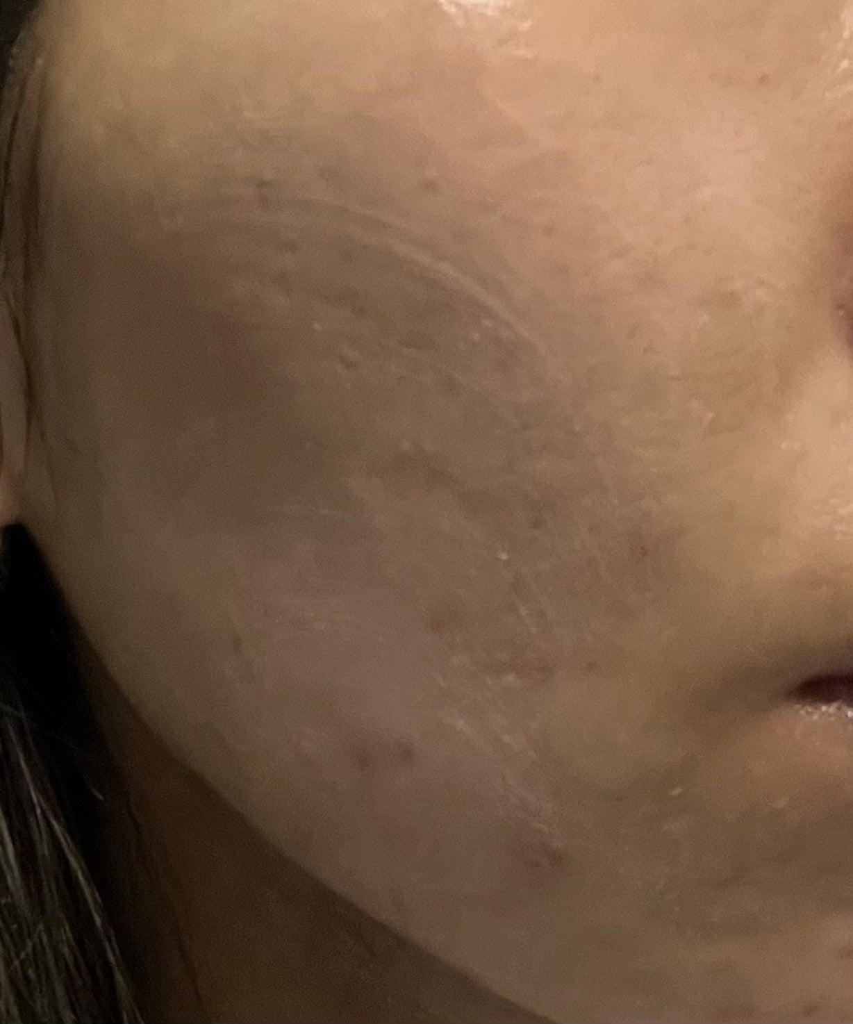 こぐまちゃん on LIPS 「塗り始めて5週目。生理前必ず肌があれ大きいニキビが1,2個でき..」(2枚目)