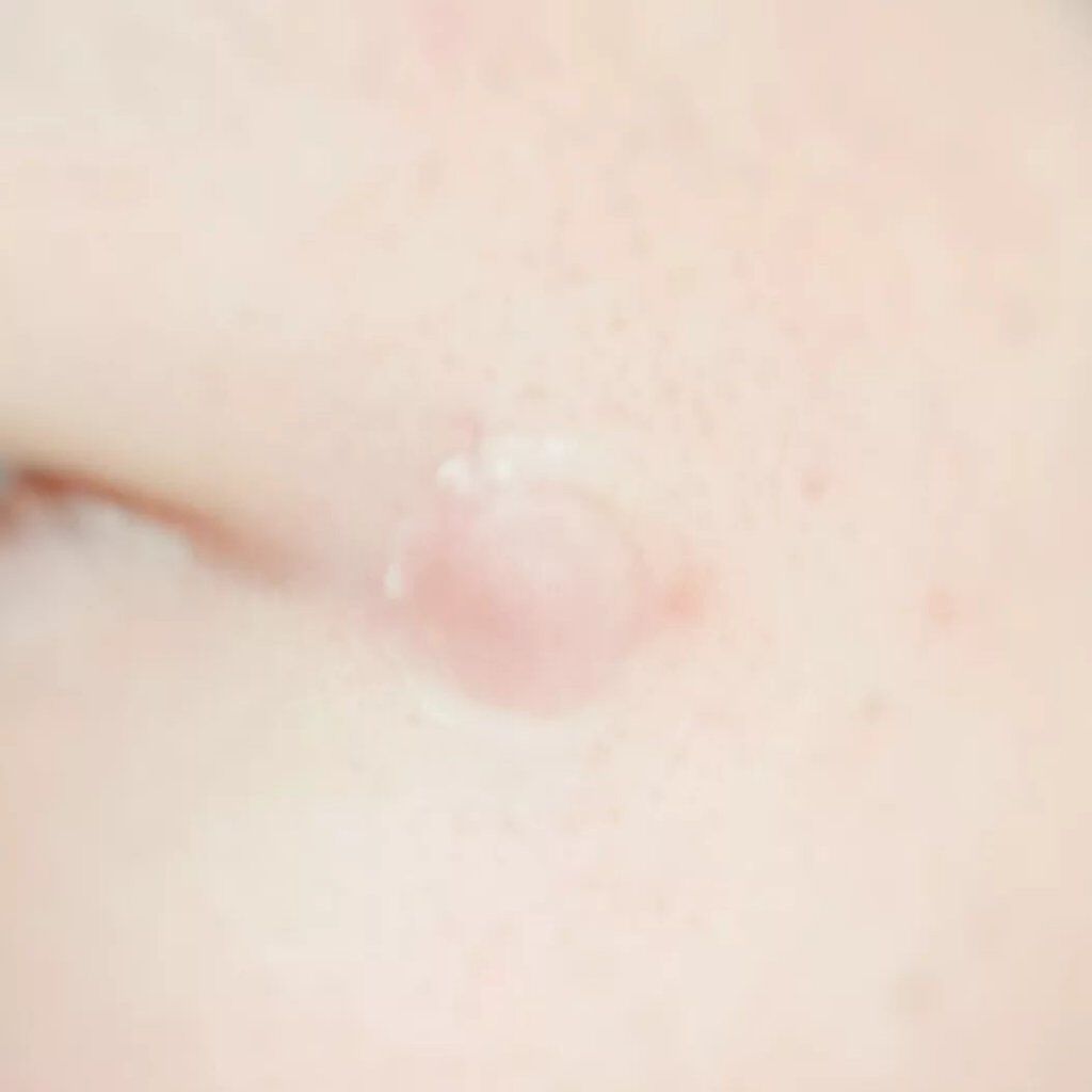 OK CICA CLEAR PATCH/GR/その他を使ったクチコミ(7枚目)