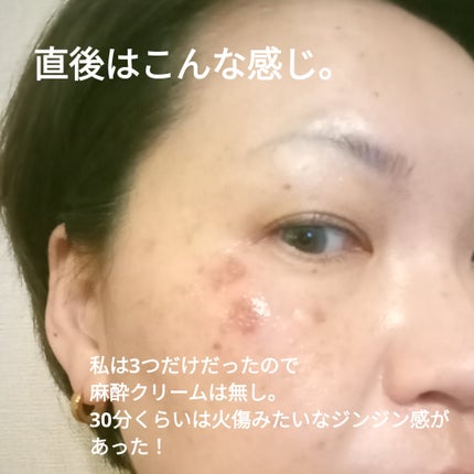 ビヨンセ奥二重向上委員長🥸LIPSパートナー🥳 on LIPS 「ついに!!この時が🤣🩷シミ取りレーザー全記録です🙌🙌🙌(五日目..」(4枚目)