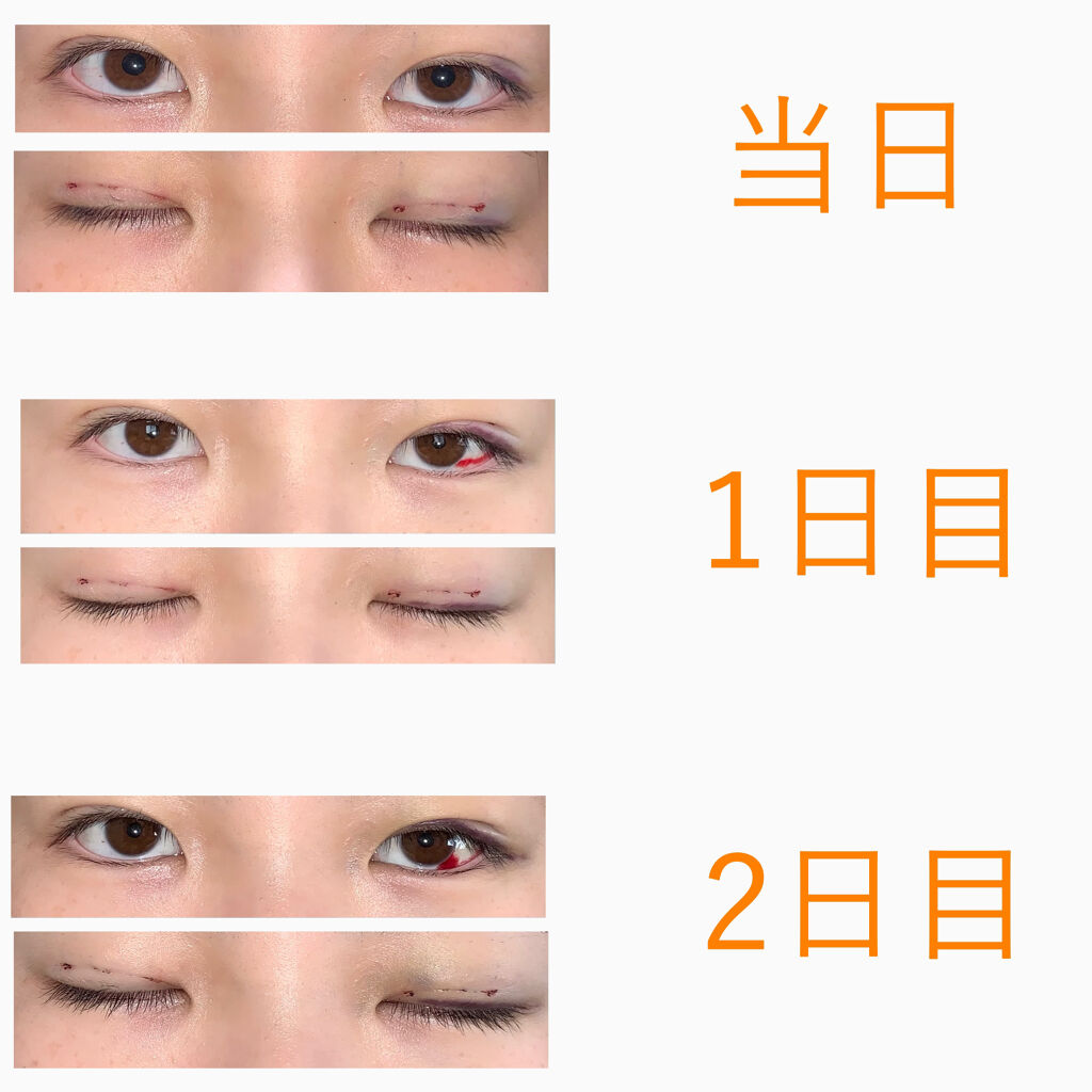 二重整形/その他を使ったクチコミ（2枚目）