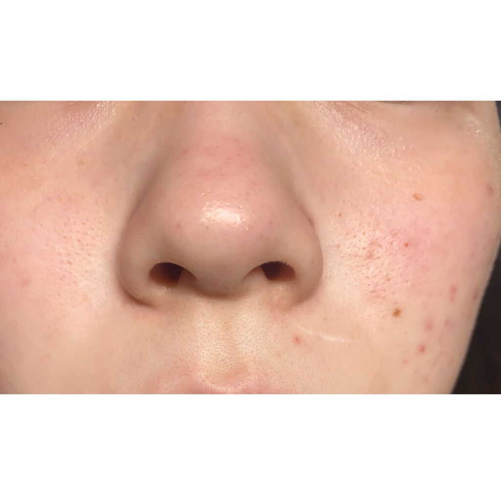 ルナ on LIPS 「ずっと肌の汚さで悩んでます!頬のニキビはマスクを着けるようにな..」(3枚目)