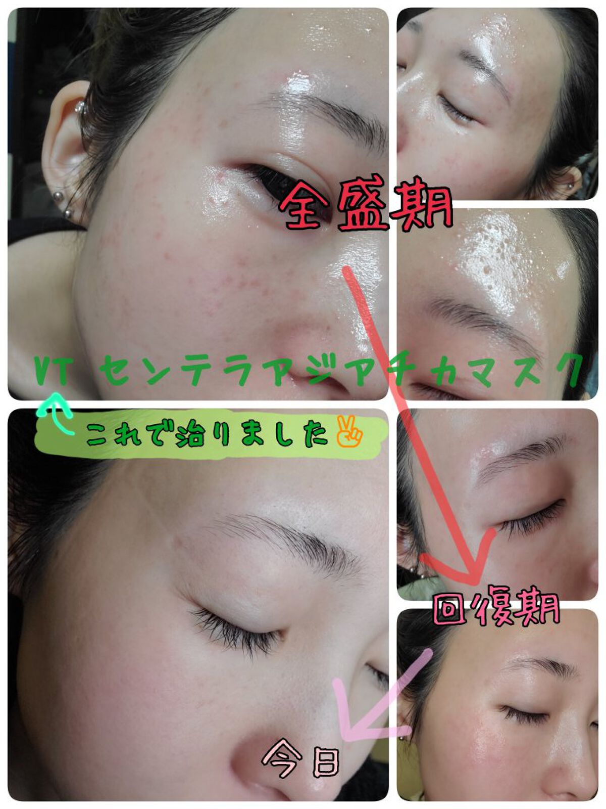 プロシカ センテラアジアチカ タイガーアンプルマスク/VT/シートマスク・パックを使ったクチコミ（1枚目）