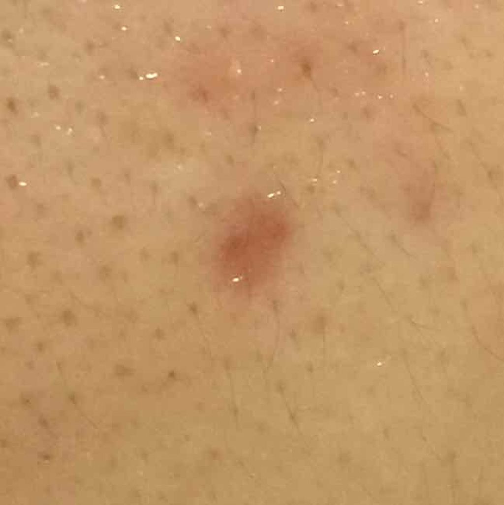 薬用 しみ 集中対策 美容液/メラノCC/美容液を使ったクチコミ(2枚目)