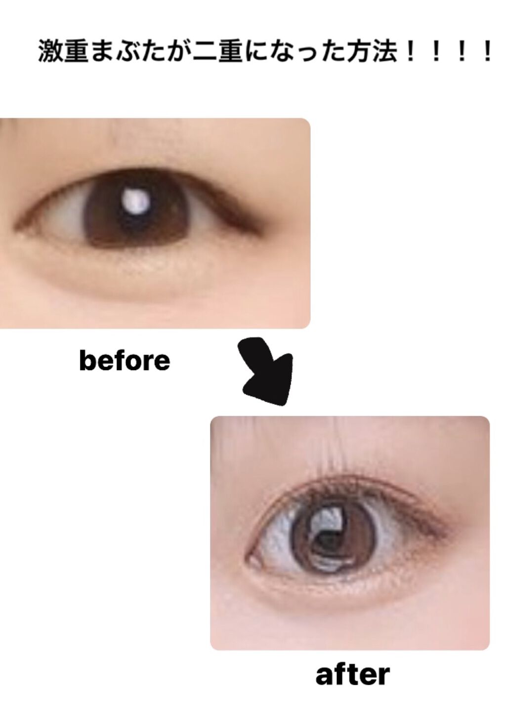 埋没式形成 くっきり二重テープ/DAISO/二重まぶた用アイテムを使ったクチコミ（1枚目）