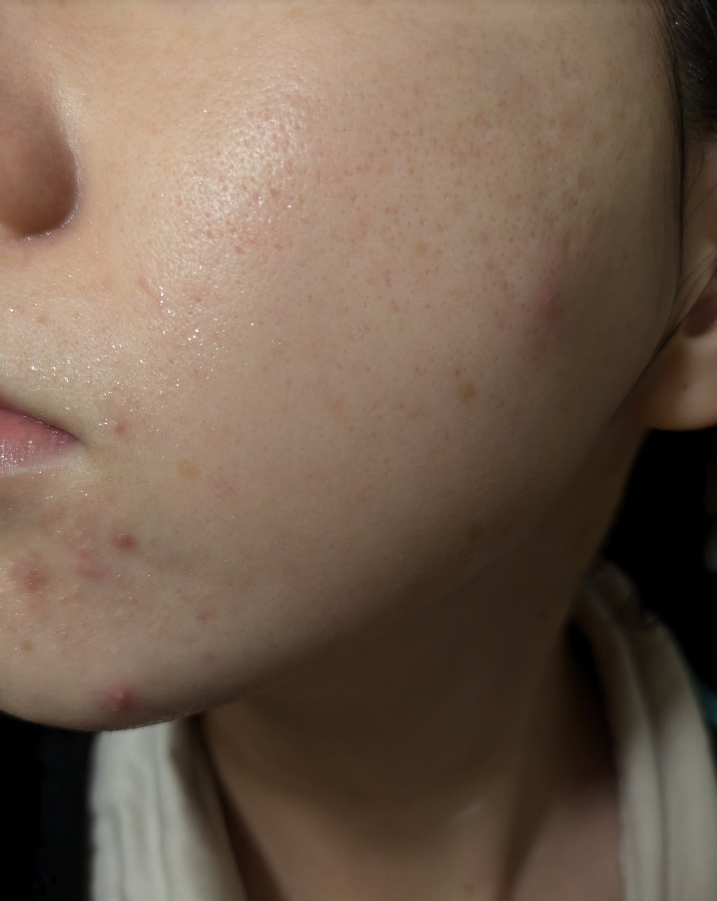 miina@汚肌工事録⚠️ on LIPS 「11/14の#汚肌工事録こう見るとあごまわりの肌がすごくダメー..」(2枚目)