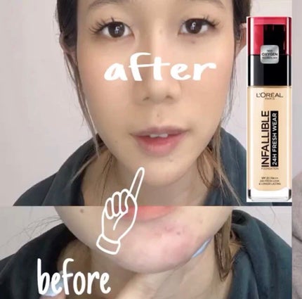 ロレアル パリ インファリブル フレッシュウェア ファンデーションのクチコミ「【ニキビ跡、赤みがある私の肌にロレアルパリのファンデーションを使ってみたら?】
✂ー.....」(2枚目)
