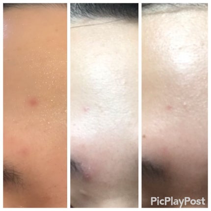 ブレミッシュケアアップ セラム/ISOI/美容液を使ったクチコミ(3枚目)