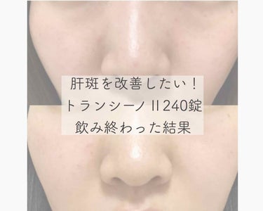 ぴよこまる on LIPS 「気がついたら、目の下にできていた肝斑。たぶん…肝斑。低容量ピル..」（1枚目）