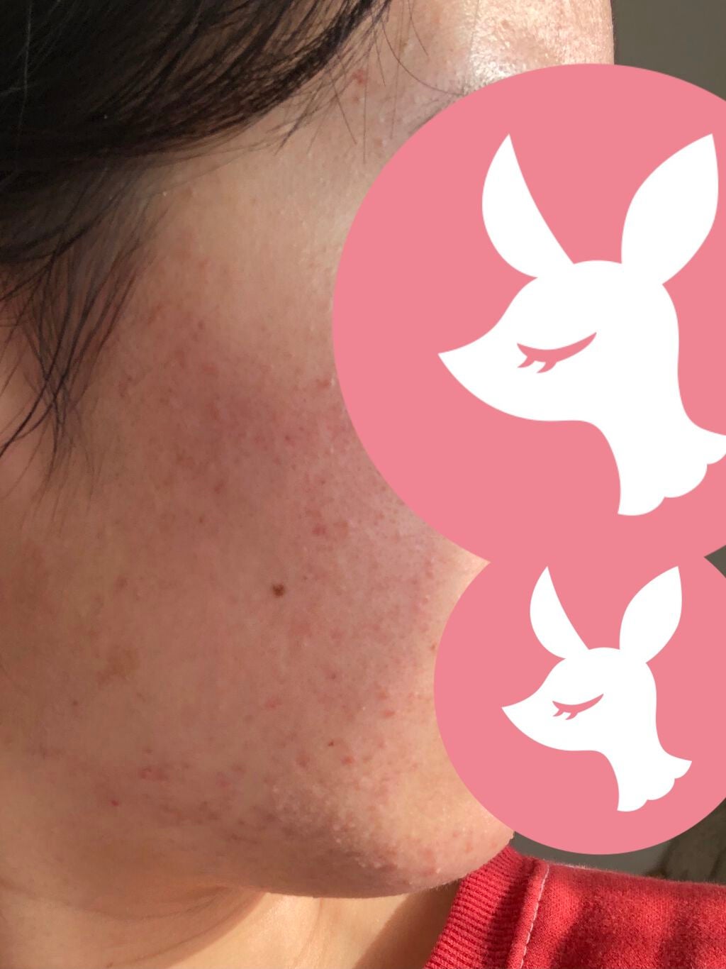 fresh_lips_b93 on LIPS 「皆様おはようございます2日目です若干ニキビが少なくなってきたか..」(1枚目)