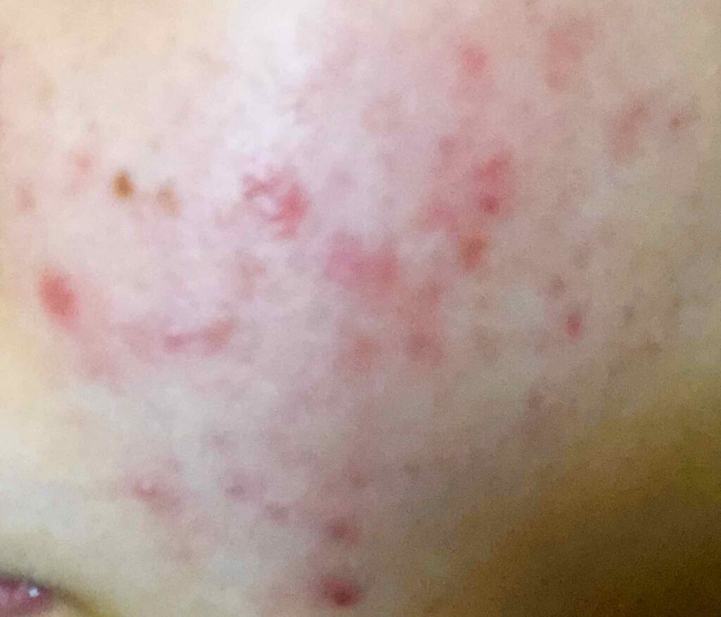 オードムーゲ 薬用ローション(ふきとり化粧水)/オードムーゲ/拭き取り化粧水を使ったクチコミ(3枚目)