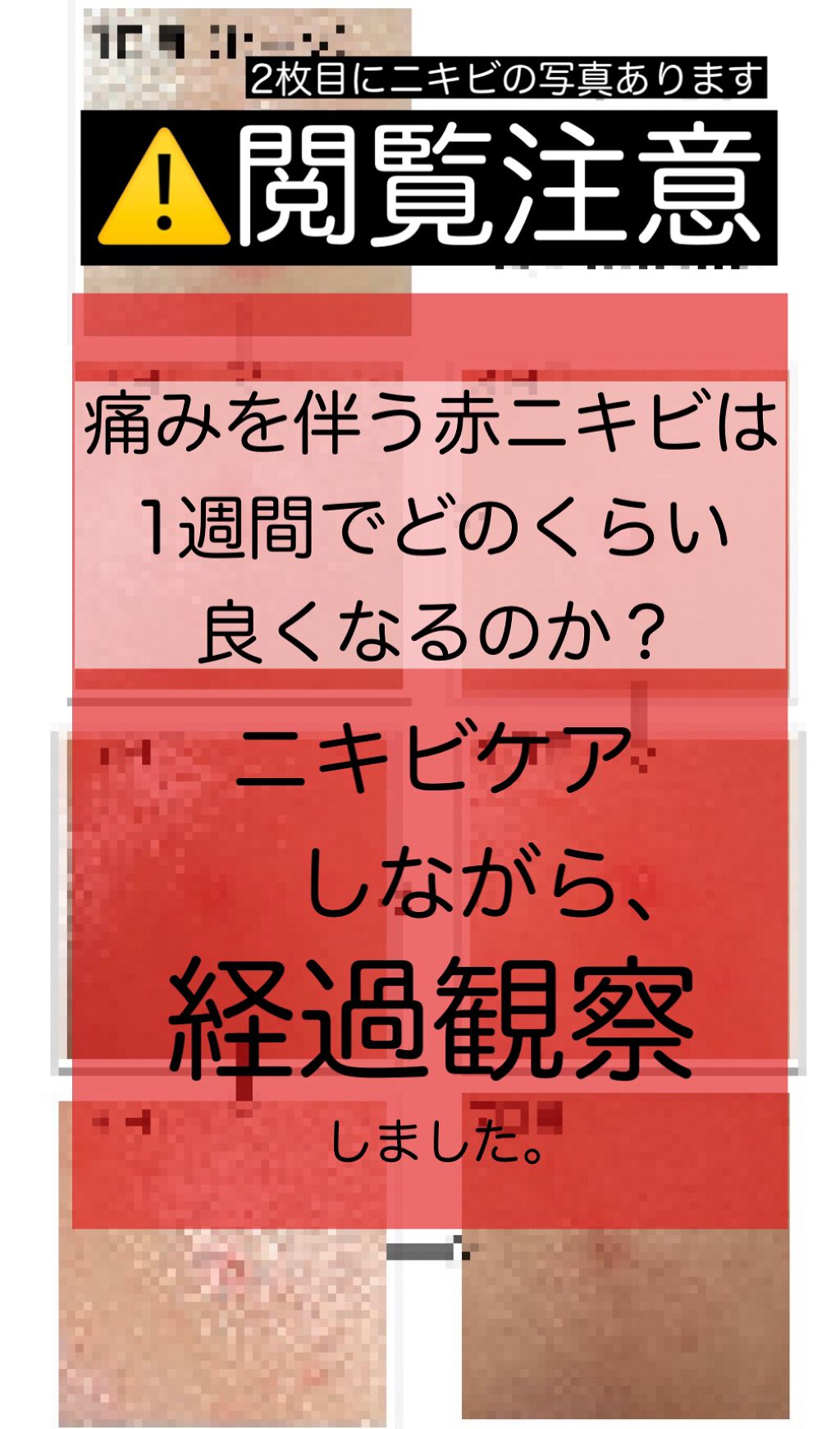A アクネローション/NOV/化粧水を使ったクチコミ（1枚目）