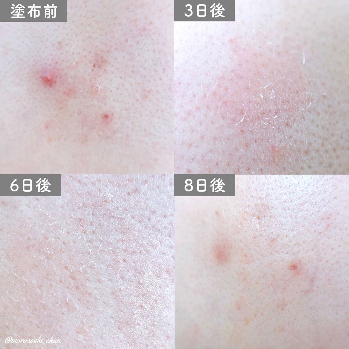 ダーマスキンピーリング/BQCELL/その他キットセットを使ったクチコミ(4枚目)