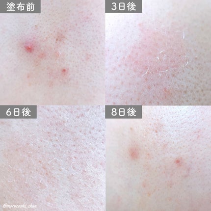 ダーマスキンピーリング/BQCELL/その他キットセットを使ったクチコミ(4枚目)