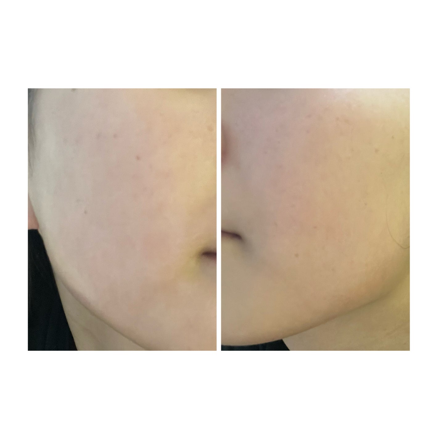 ぽむ on LIPS 「2023.9.13皮膚科に受診 エピデュオとヘパリン処方1枚目..」(3枚目)