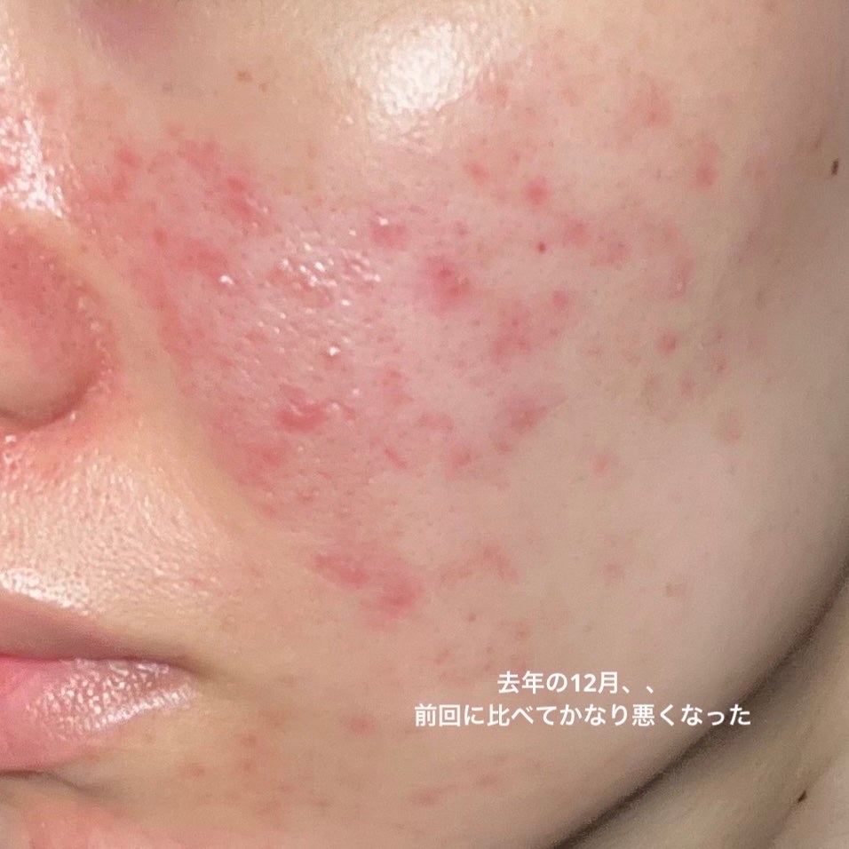 ビタペアC 集中美容液スペシャルセット/ネイチャーリパブリック/美容液を使ったクチコミ(2枚目)