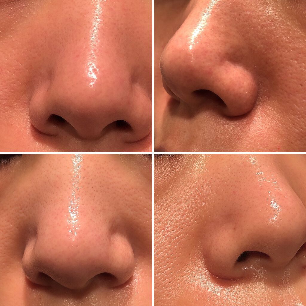 マツさん on LIPS 「オイリー肌の記録。乳液をやめて、皮脂に自由を与えてる図。上が寝..」(2枚目)