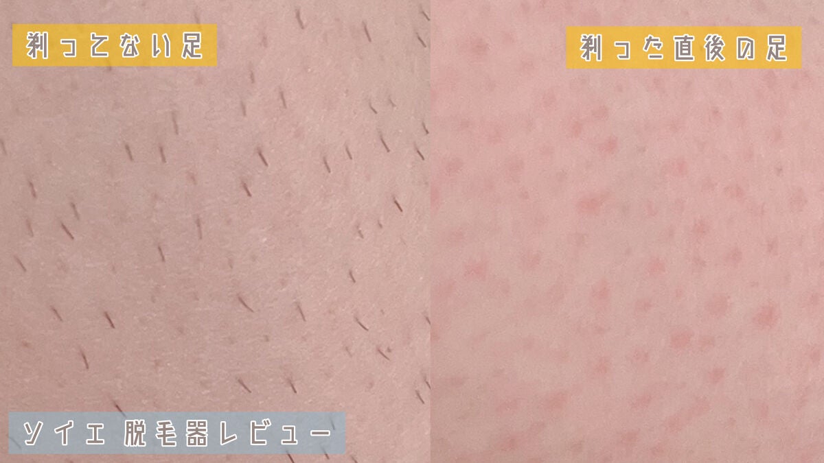 脱毛器 ソイエ ES-WS35 /Panasonic/家庭用脱毛器を使ったクチコミ(5枚目)