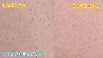 脱毛器 ソイエ ES-WS35 /Panasonic/家庭用脱毛器を使ったクチコミ(5枚目)