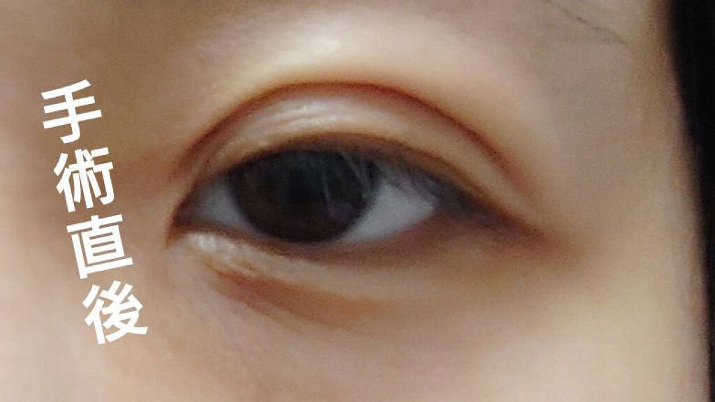 みぃぬ on LIPS 「二重埋没してから2週間経過しました。カラコンあり、フルメイクし..」(3枚目)