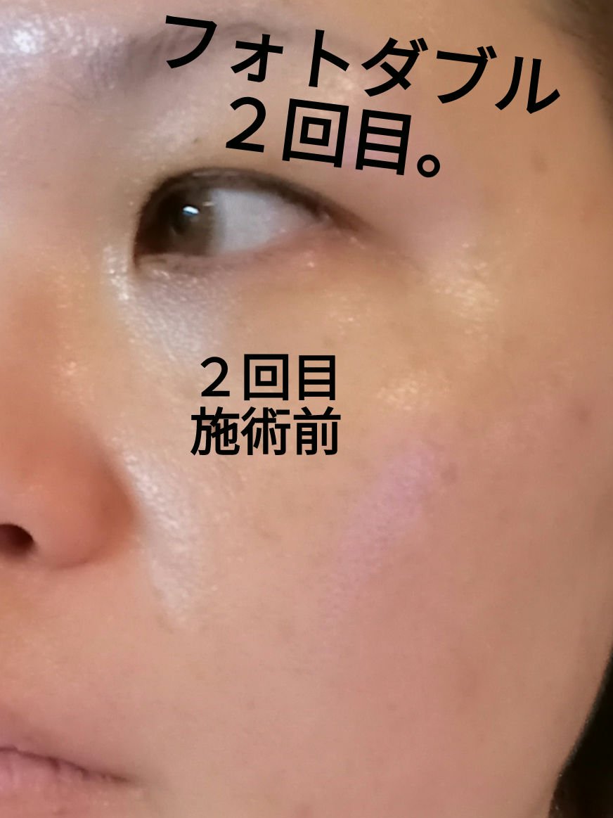 フォトダブル/湘南美容クリニック/その他を使ったクチコミ（1枚目）