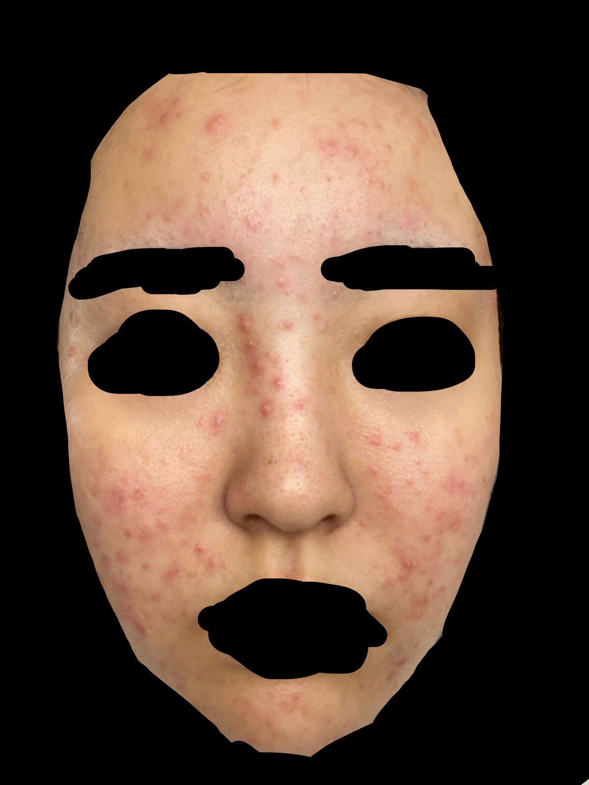 オードムーゲ 薬用ローション（ふきとり化粧水）/オードムーゲ/拭き取り化粧水を使ったクチコミ（3枚目）