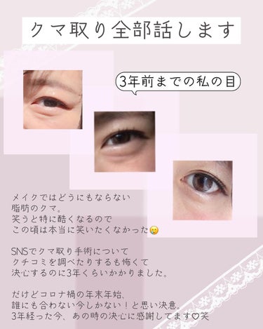 ぴーちゃん🧡 on LIPS 「クマ取り体験談/┈┈┈┈┈┈┈┈┈┈ストーリーズにダウンタイム..」（2枚目）