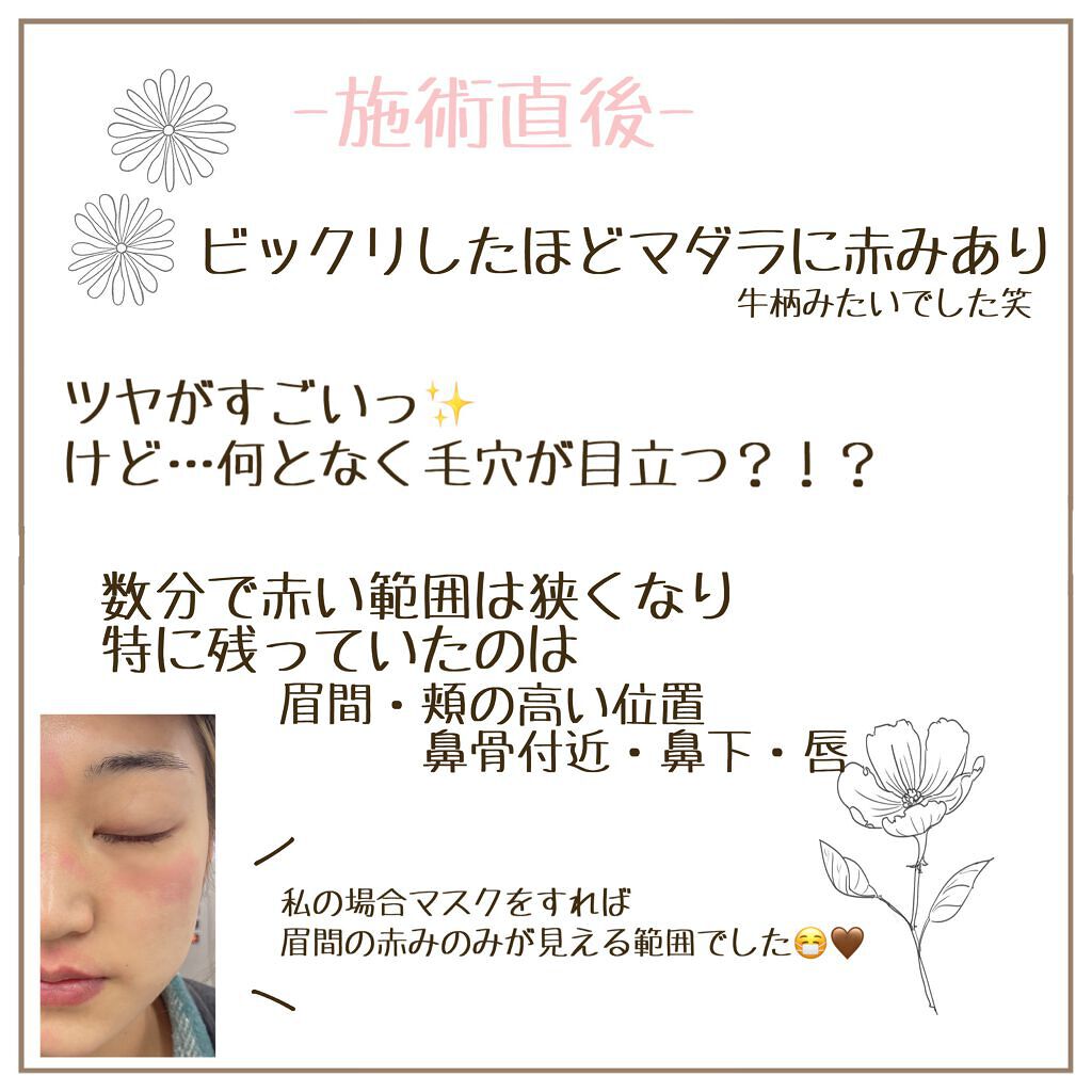 試してみた】MCダブルピーリングプロ リフトケアPLUS ミュゼ 試してみた】MCダブルピーリングプロ リフトケアPLUS ミュゼ