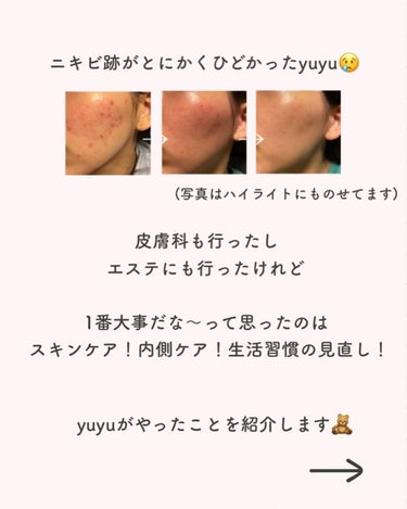 yuyu🐶肌荒れ体質の正直レビュー on LIPS 「【ニキビ跡を薄くするためにやったこと20リスト📝】✼••┈┈•..」（2枚目）