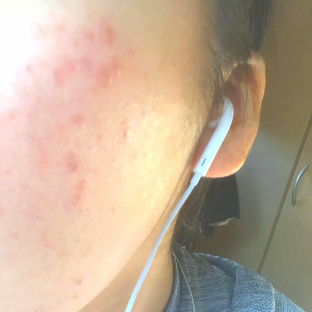 ペアアクネクリームW(医薬品)/ペア/その他を使ったクチコミ(1枚目)