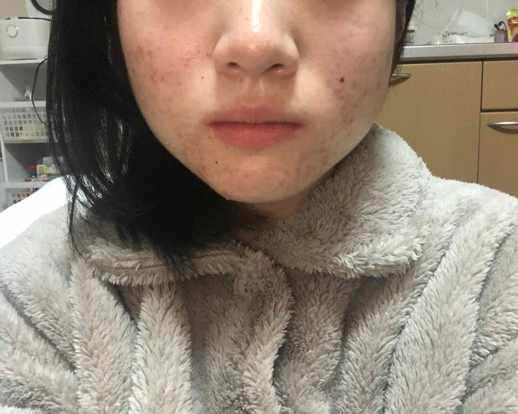 マンスリースキンケアプログラム(旧)/APEX/スキンケアキットを使ったクチコミ(2枚目)