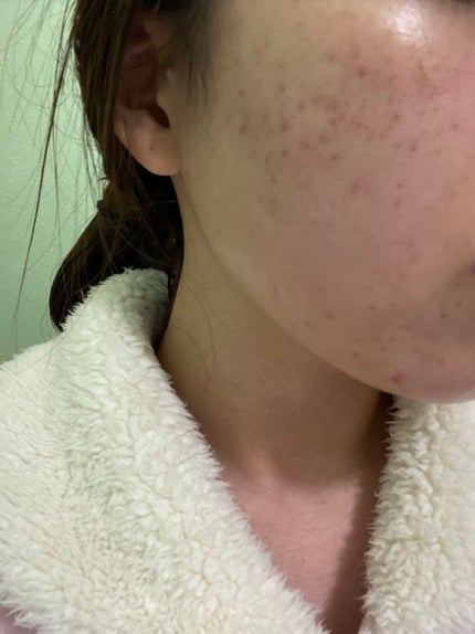 ケシミンクリームc/ケシミン/フェイスクリームを使ったクチコミ(1枚目)