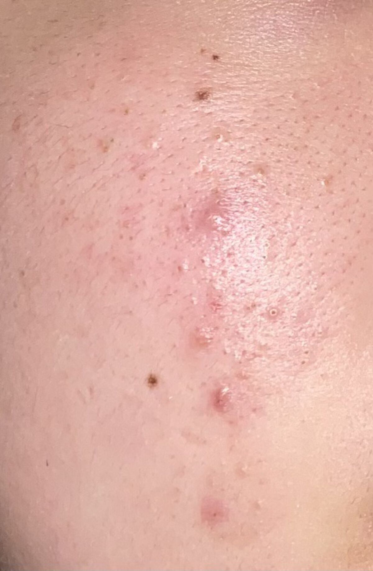 ACアクティブ トライアルセット/NOV/トライアルキットを使ったクチコミ（1枚目）