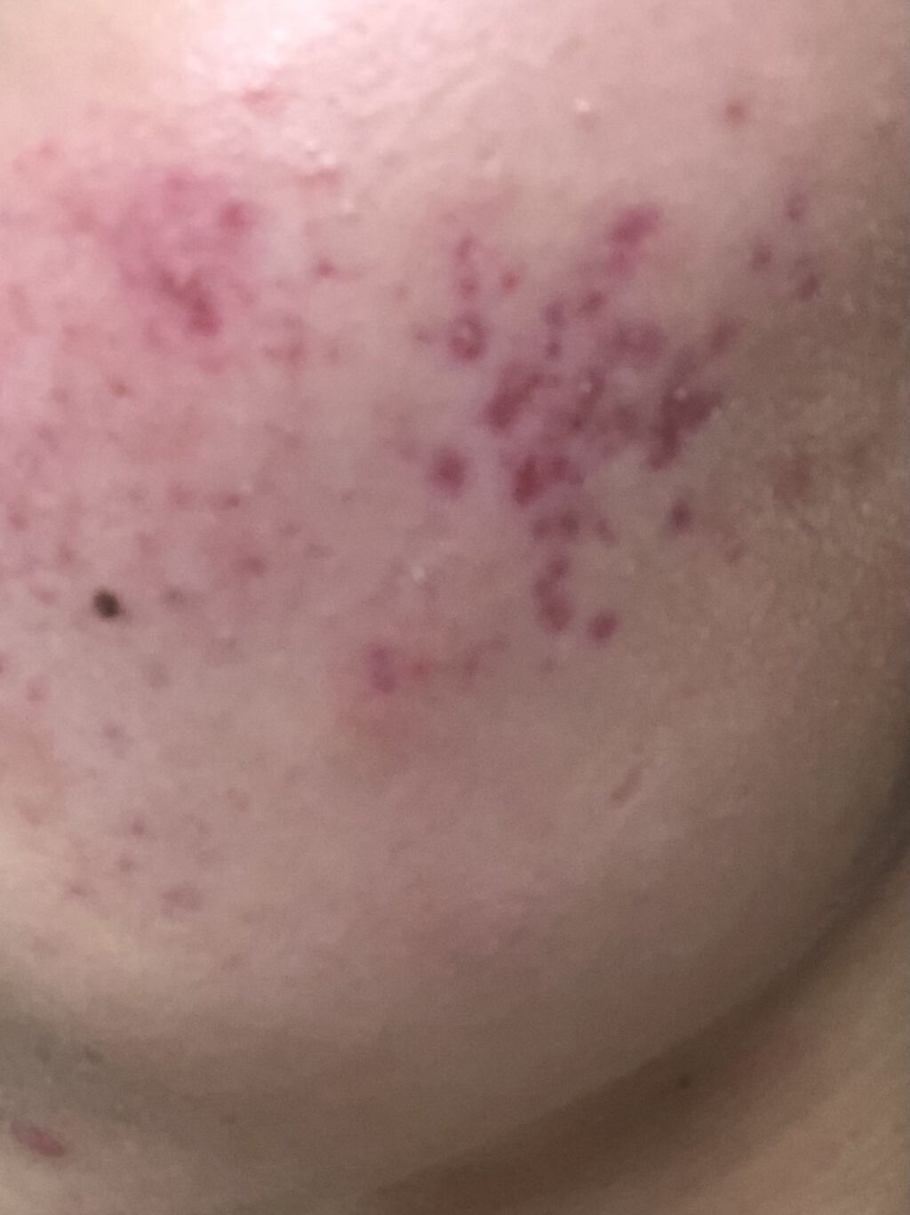 ビーソフテン ローション(医薬品)/持田製薬/その他を使ったクチコミ（1枚目）