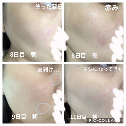 EUKROMA ハイドロキノンクリーム4% 20g/EUKROMA/その他スキンケアを使ったクチコミ(2枚目)