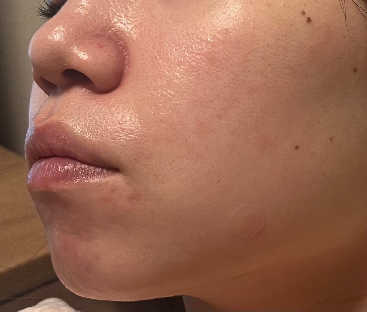 A アクネフォーム/NOV/洗顔フォームを使ったクチコミ(3枚目)