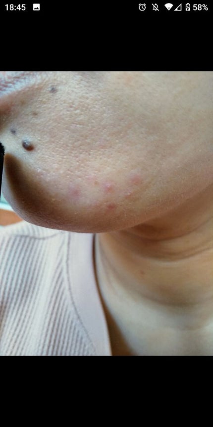 薬用しみ集中対策 プレミアム美容液/メラノCC/美容液を使ったクチコミ(2枚目)