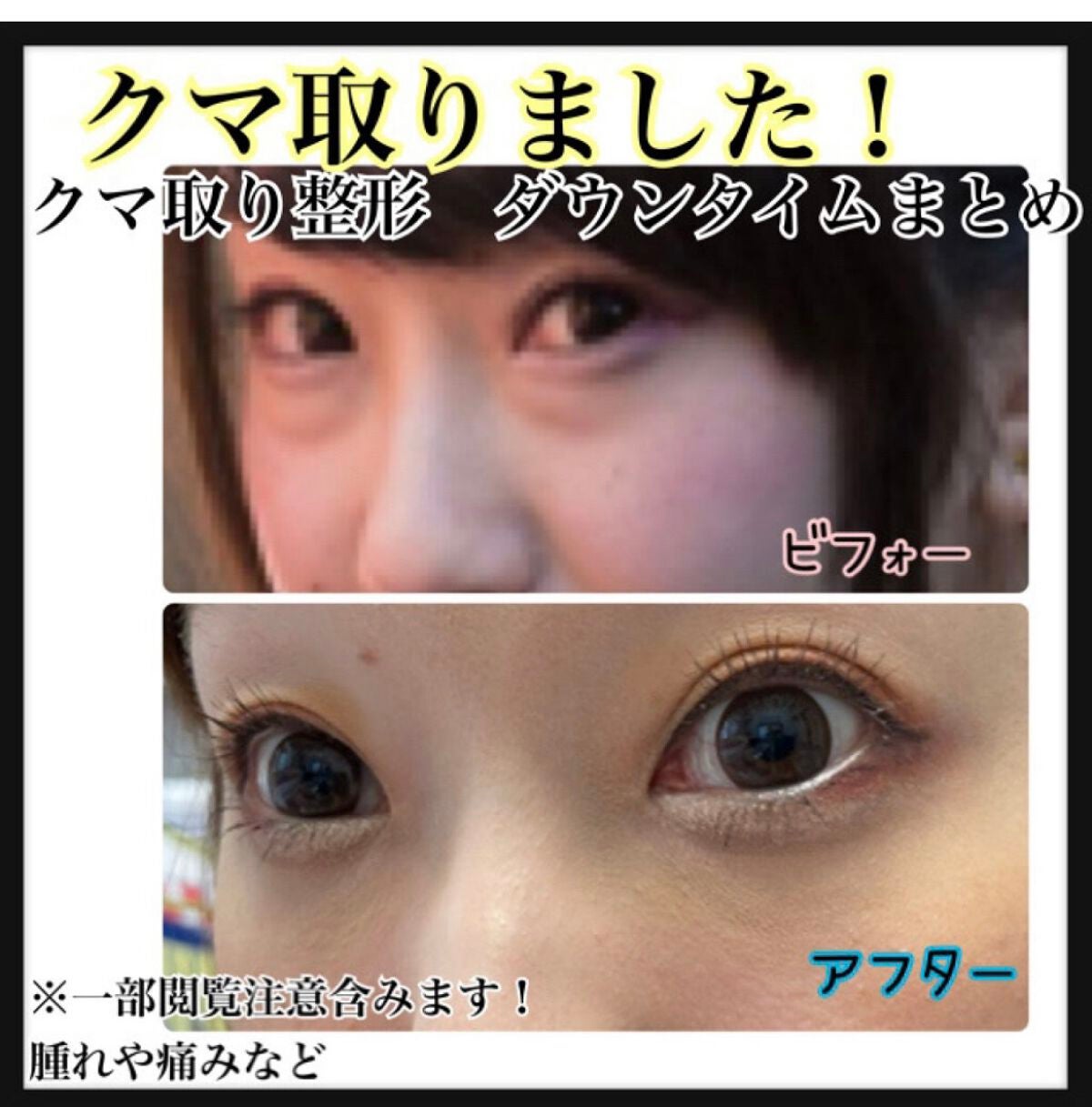 【旧】ディオールスキン フォーエヴァー スキン コレクト コンシーラー/Dior/リキッドコンシーラーを使ったクチコミ(1枚目)