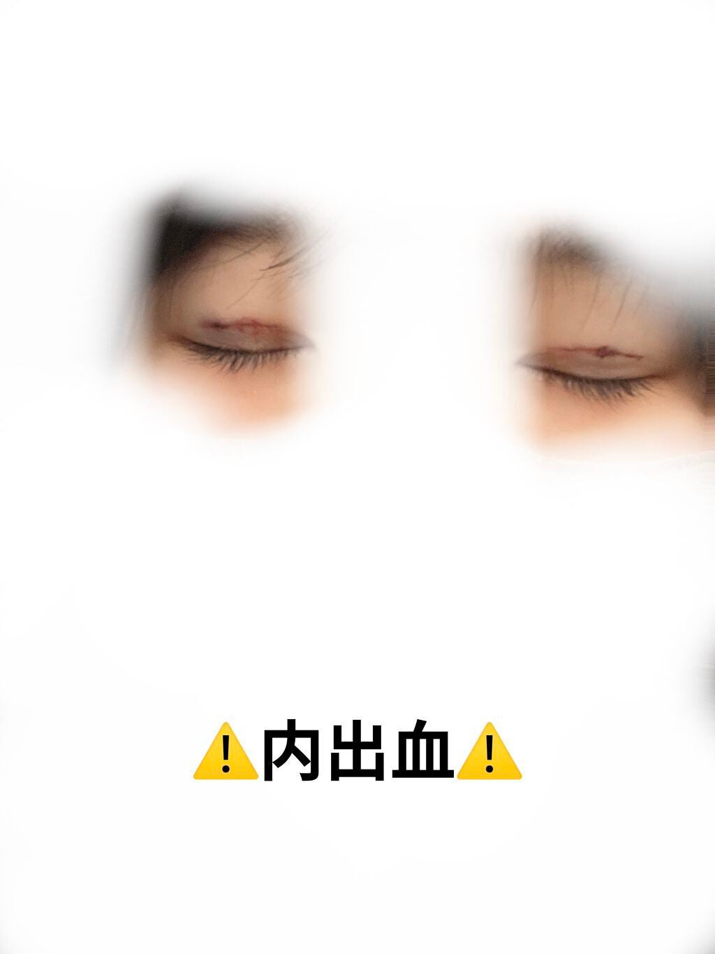 ダッフィー on LIPS 「埋没レポ湘南美容外科  〜teen二重術〜(週末二重術)料金 ..」(3枚目)