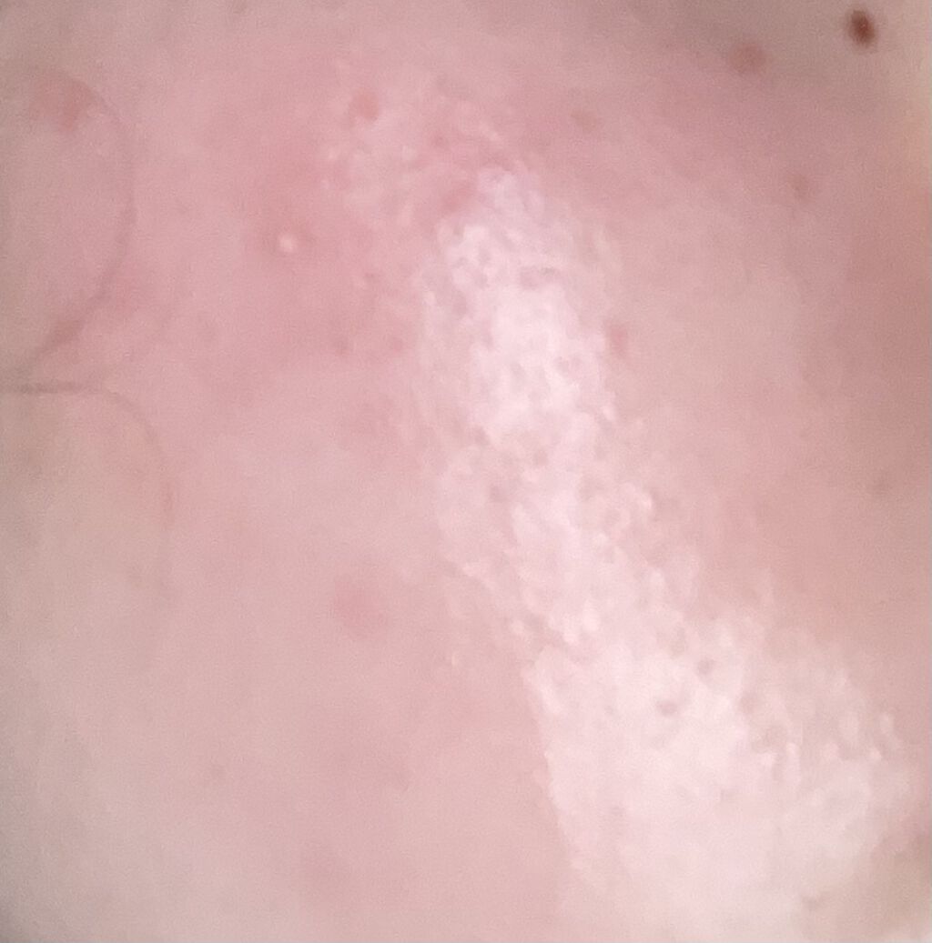 デュアック配合ゲル/美容皮膚科/フェイスクリームを使ったクチコミ（2枚目）