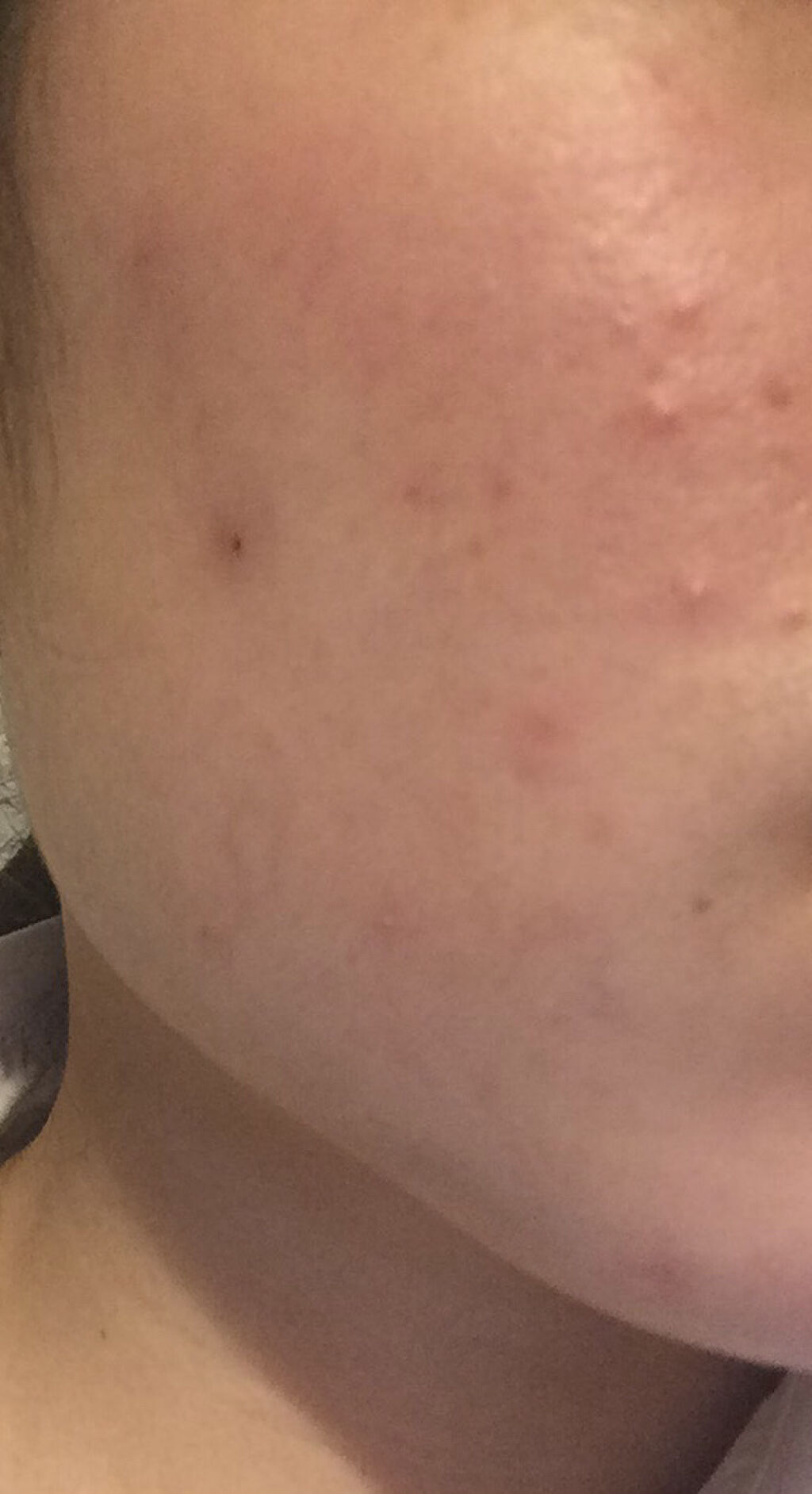 オードムーゲ 薬用ローション（ふきとり化粧水）/オードムーゲ/拭き取り化粧水を使ったクチコミ（2枚目）