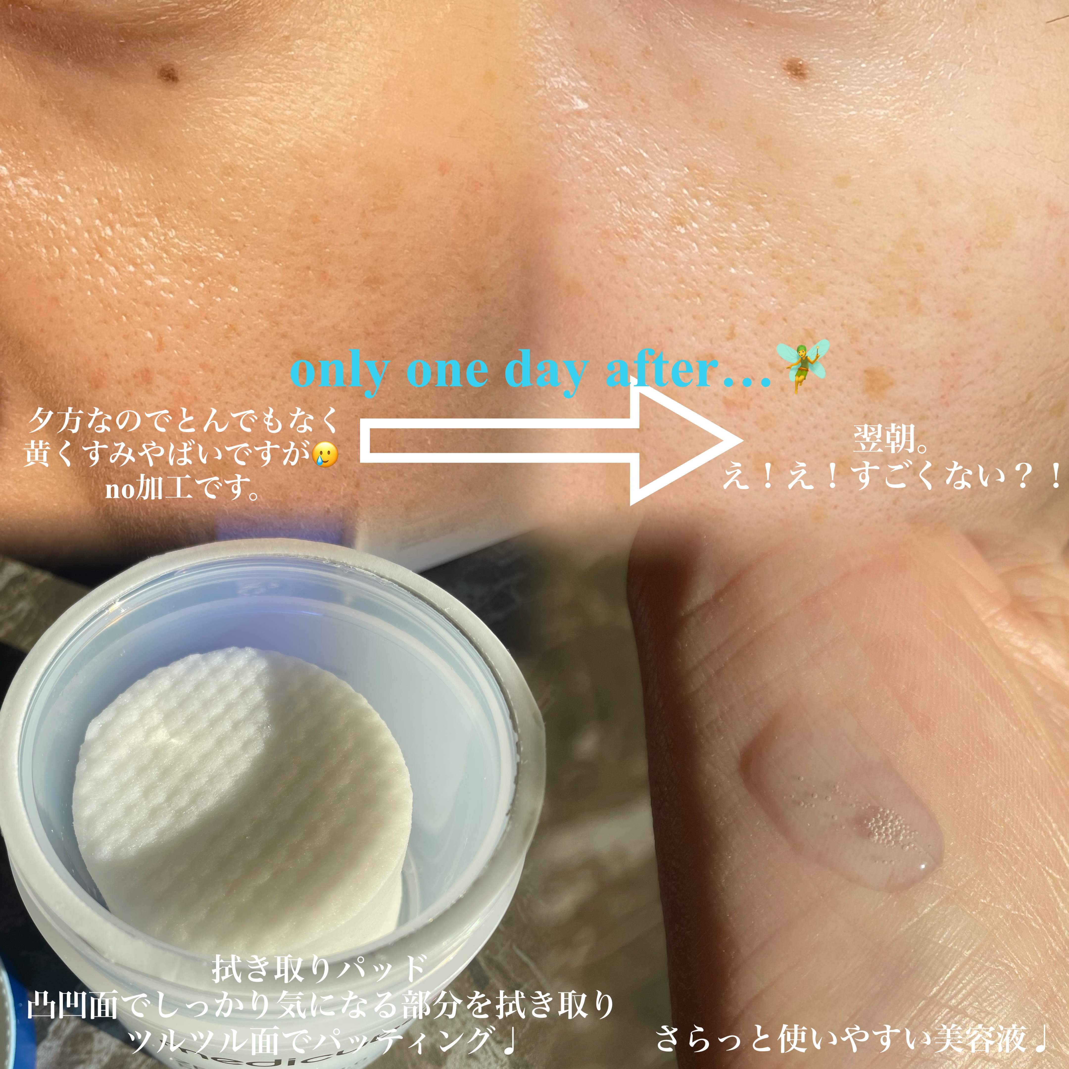 ゼロ毛穴1DAYセラム/MEDICUBE/美容液を使ったクチコミ（2枚目）