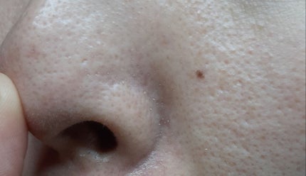 CaTiony ウォーターピーリングのクチコミ「ウォーターピーリング、前から気になってて買っちゃいました。結果、角栓かなりとれました!1回目は.....」(3枚目)