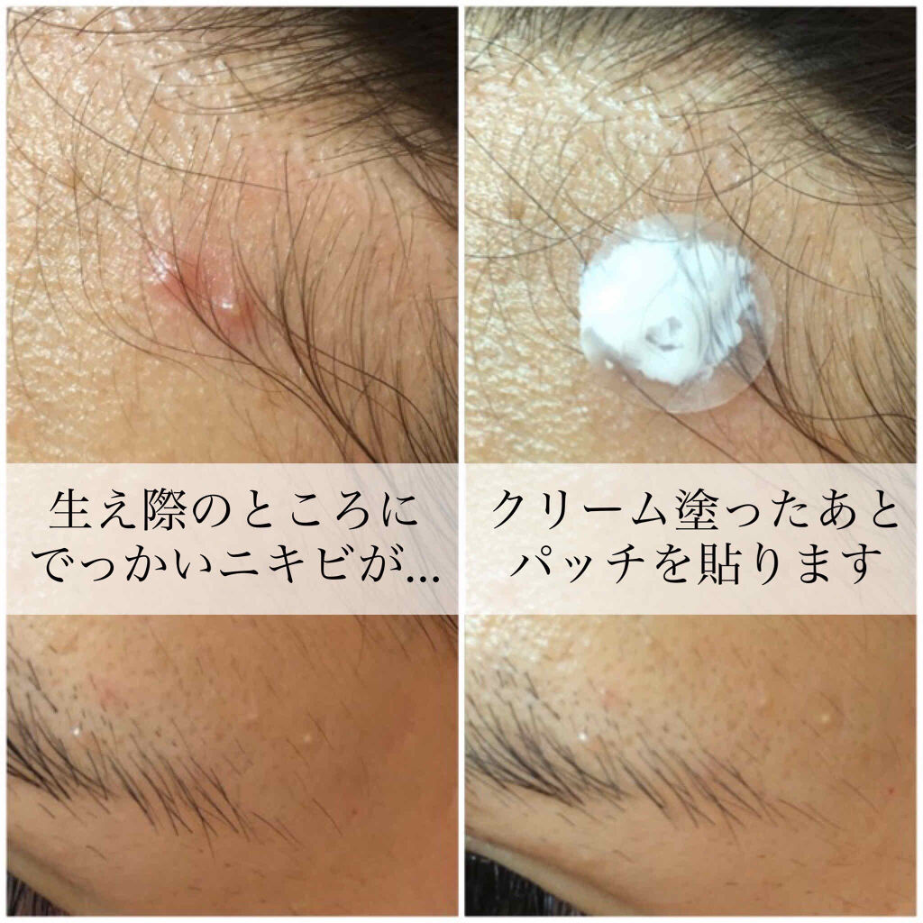 薬用ニキビケア スポッツクリーム アクネスラボの効果に関する口コミ ニキビケアにおすすめのフェイスクリーム おでこにデッカイ炎症ニ By おたむ フォロバ99 混合肌 代後半 Lips