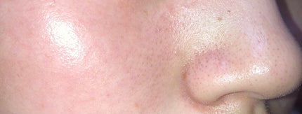 赫音 on LIPS 「1.2枚目は8/25(白ニキビかました)3.4枚目は8/17少..」(4枚目)