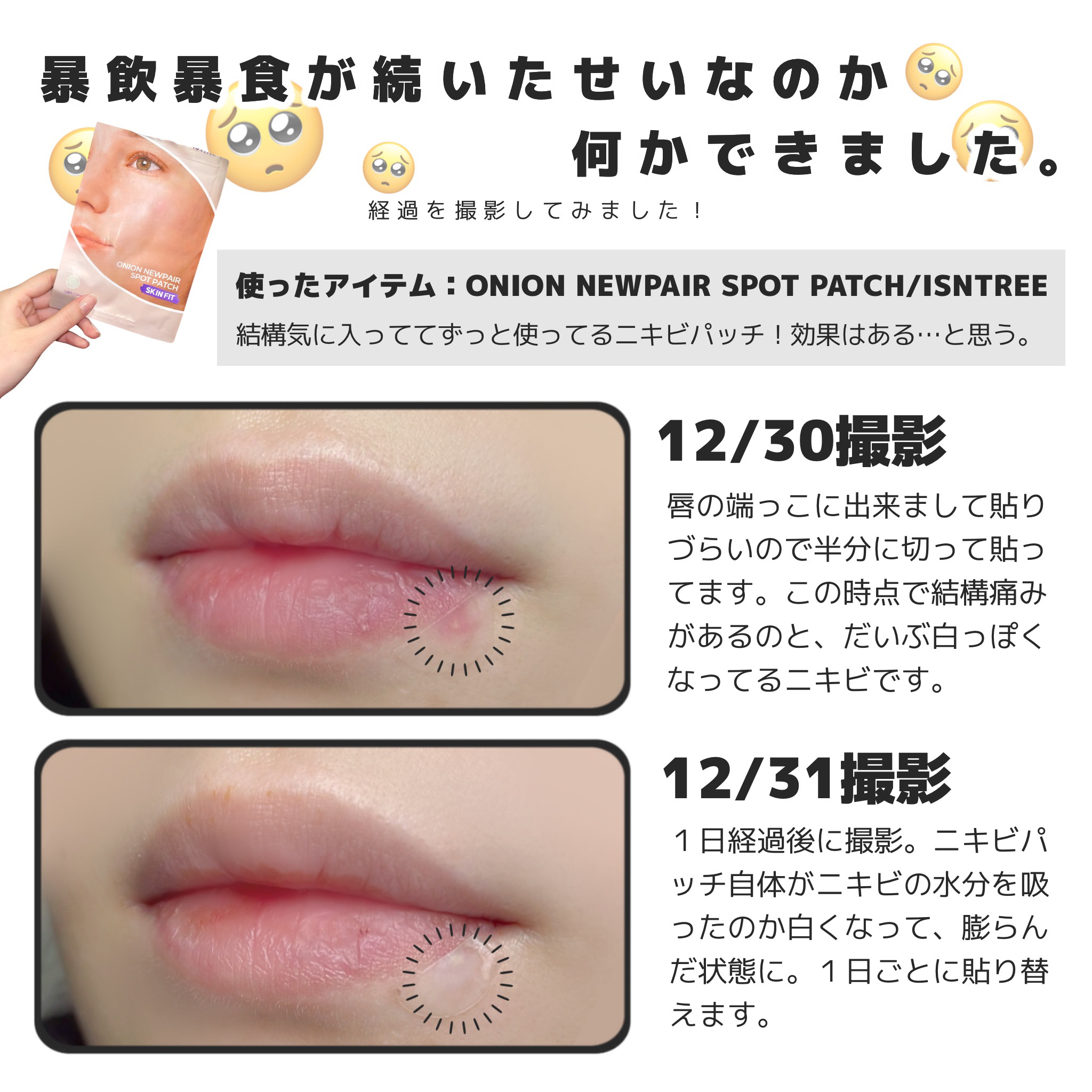 オニオンニューペアスポットパッチ スキンフィット/Isntree/にきびパッチを使ったクチコミ（3枚目）