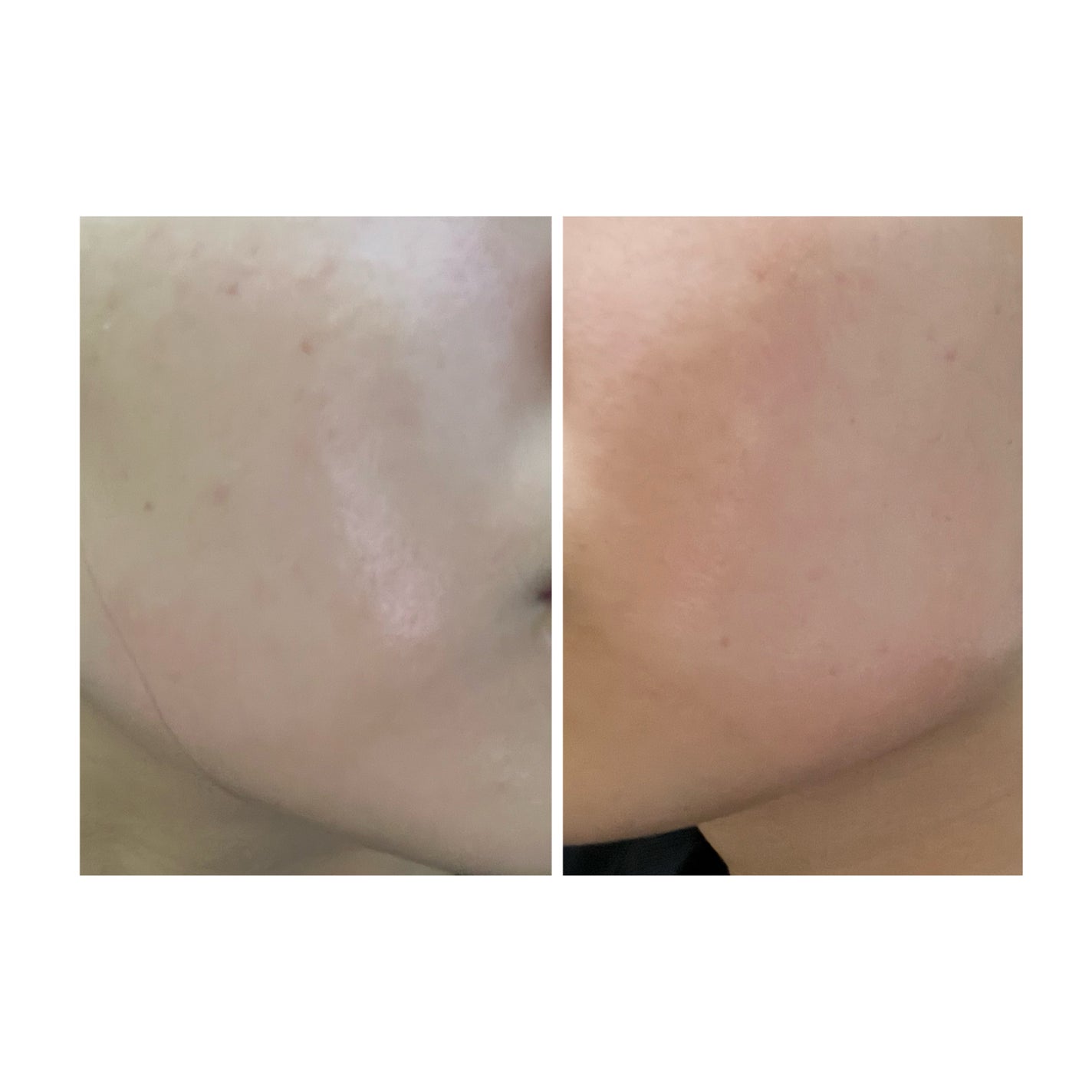 ぽむ on LIPS 「2023.9.13皮膚科に受診 エピデュオとヘパリン処方1枚目..」(5枚目)