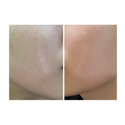 ぽむ on LIPS 「2023.9.13皮膚科に受診 エピデュオとヘパリン処方1枚目..」(5枚目)