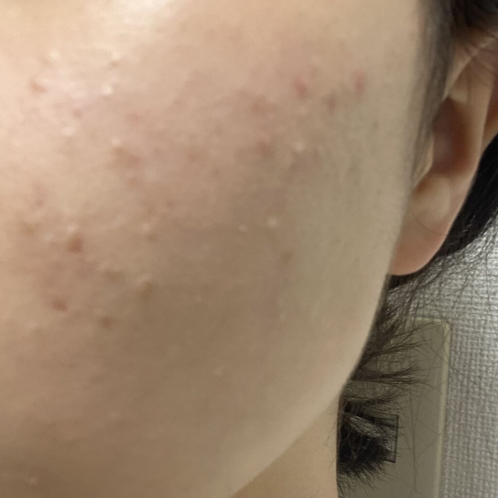 ティーツリーケアソリューション アンプルマスクJEX/MEDIHEAL/シートマスク・パックを使ったクチコミ（2枚目）